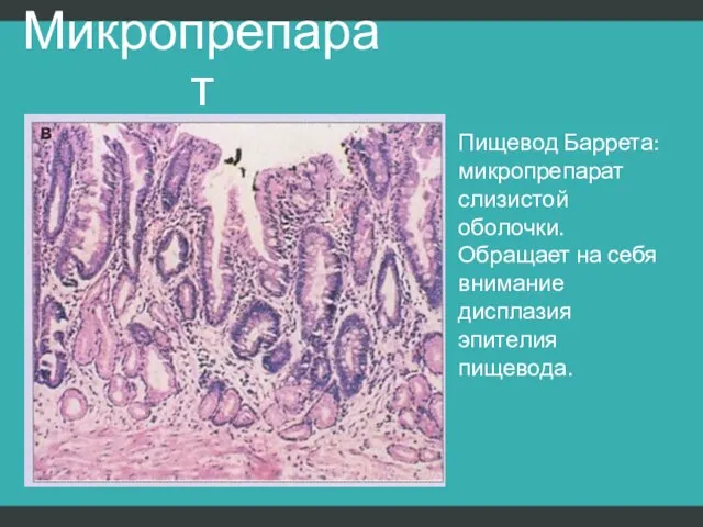 Микропрепарат Пищевод Баррета: микропрепарат слизистой оболочки. Обращает на себя внимание дисплазия эпителия пищевода.