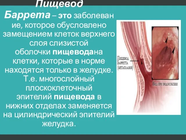 Пищевод Баррета – это заболевание, которое обусловлено замещением клеток верхнего слоя слизистой