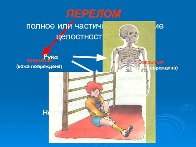 полное или частичное нарушение целостности кости. Рука ПЕРЕЛОМ Нога Открытый (кожа повреждена) Закрытый (кожа не повреждена)