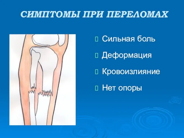 СИМПТОМЫ ПРИ ПЕРЕЛОМАХ Сильная боль Деформация Кровоизлияние Нет опоры