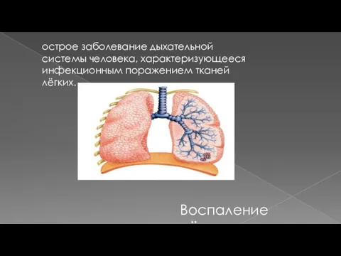 острое заболевание дыхательной системы человека, характеризующееся инфекционным поражением тканей лёгких. Воспаление лёгких