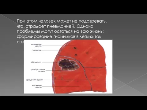 При этом человек может не подозревать, что страдает пневмонией. Однако проблемы могут