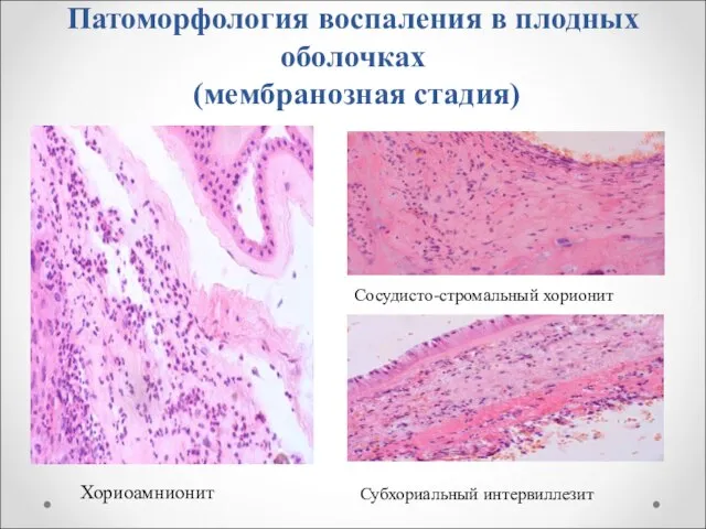 Патоморфология воспаления в плодных оболочках (мембранозная стадия) Хориоамнионит Субхориальный интервиллезит Сосудисто-стромальный хорионит