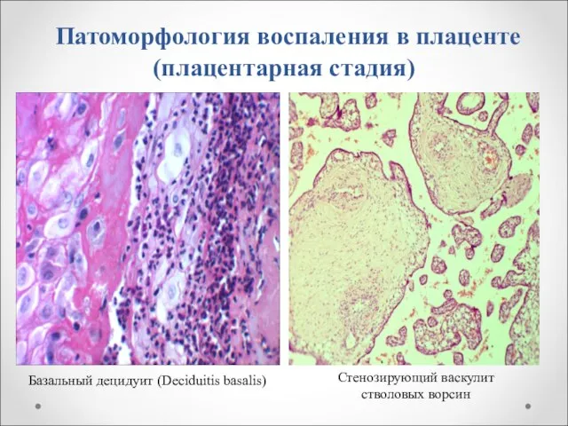 Патоморфология воспаления в плаценте (плацентарная стадия) Базальный децидуит (Deciduitis basalis) Стенозирующий васкулит стволовых ворсин