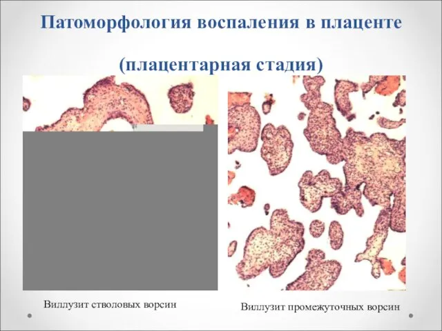 Патоморфология воспаления в плаценте (плацентарная стадия) Виллузит стволовых ворсин Виллузит промежуточных ворсин