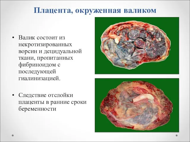 Плацента, окруженная валиком Валик состоит из некротизированных ворсин и децидуальной ткани, пропитанных