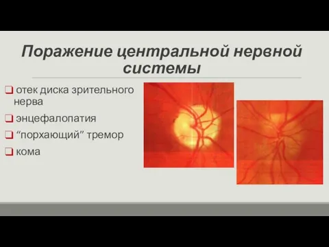Поражение центральной нервной системы отек диска зрительного нерва энцефалопатия “порхающий” тремор кома