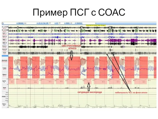 Пример ПСГ с СОАС