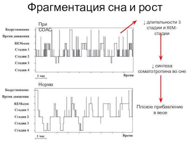 Фрагментация сна и рост Норма При СОАС ↓ длительности 3 стадии и