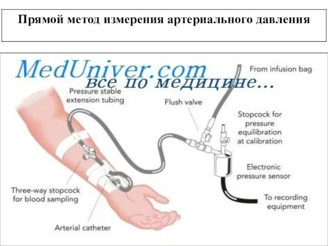 Прямой метод измерения артериального давления