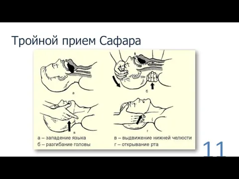 Тройной прием Сафара