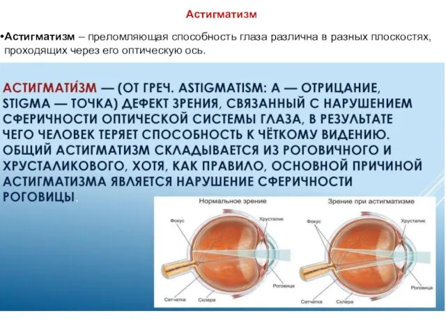 Астигматизм Астигматизм – преломляющая способность глаза различна в разных плоскостях, проходящих через его оптическую ось.