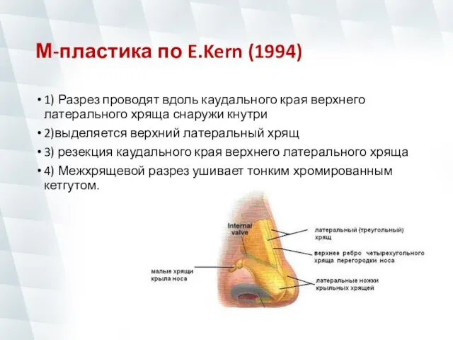 М-пластика по E.Kern (1994) 1) Разрез проводят вдоль каудального края верхнего латерального