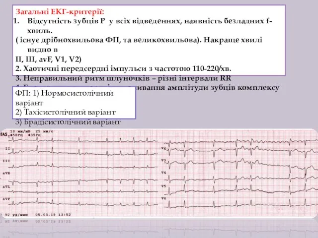 Загальні ЕКГ-критерії: Відсутність зубців P у всіх відведеннях, наявність безладних f-хвиль. (