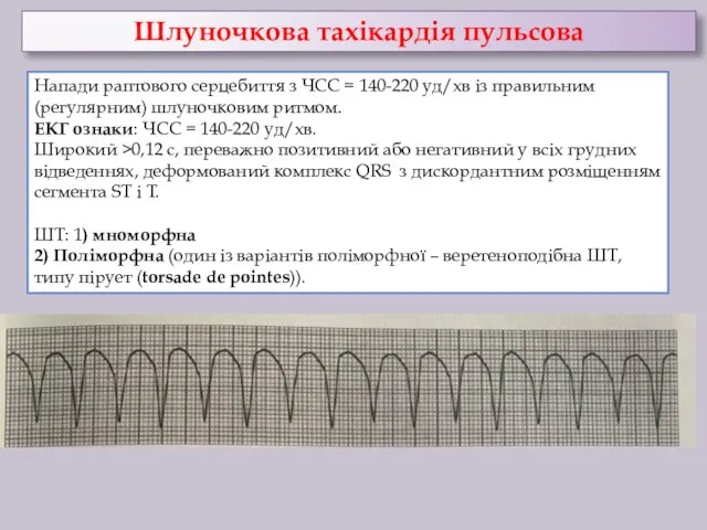 Шлуночкова тахікардія пульсова Напади раптового серцебиття з ЧСС = 140-220 уд/хв із