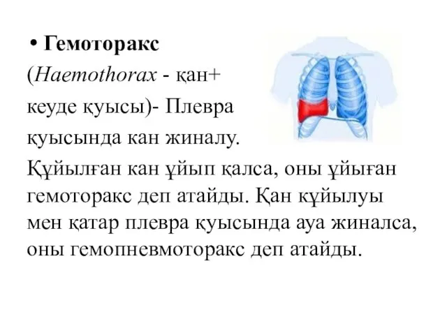 Гемоторакс (Haemothorax - қан+ кеуде қуысы)- Плевра қуысында кан жиналу. Құйылған кан