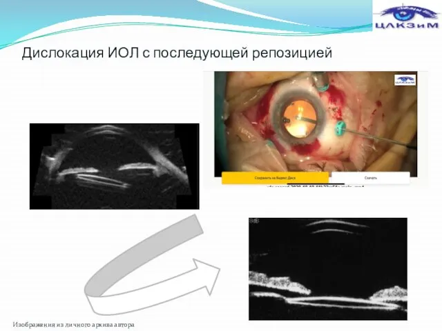 Дислокация ИОЛ с последующей репозицией Изображения из личного архива автора