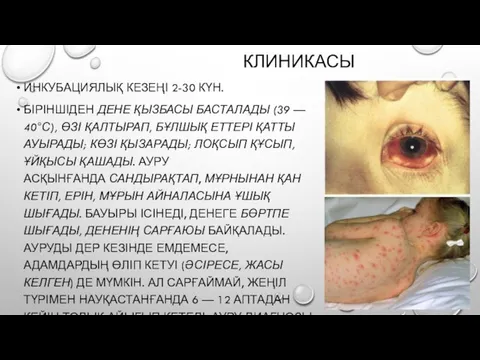 КЛИНИКАСЫ ИНКУБАЦИЯЛЫҚ КЕЗЕҢІ 2-30 КҮН. БІРІНШІДЕН ДЕНЕ ҚЫЗБАСЫ БАСТАЛАДЫ (39 — 40°С),