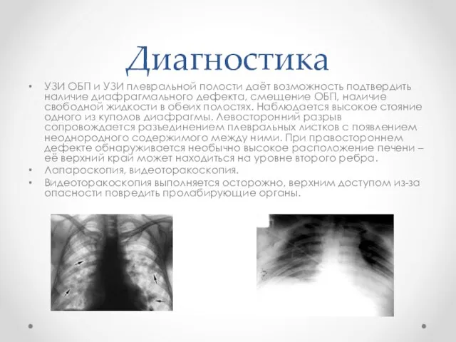 Диагностика УЗИ ОБП и УЗИ плевральной полости даёт возможность подтвердить наличие диафрагмального