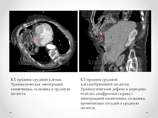 КТ органов грудной клетки/брюшной полости. Травматический дефект в передних отделах диафрагмы справа