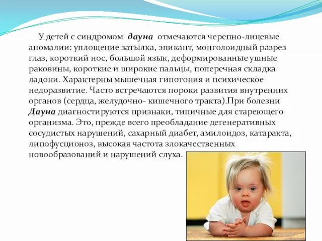 У детей с синдромом дауна отмечаются черепно-лицевые аномалии: уплощение затылка, эпикант, монголоидный