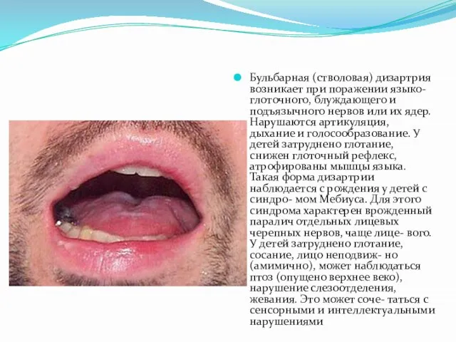 Бульбарная (стволовая) дизартрия возникает при поражении языко-глоточного, блуждающего и подъязычного нервов или