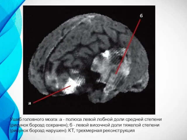 Ушиб головного мозга: а - полюса левой лобной доли средней степени (рисунок