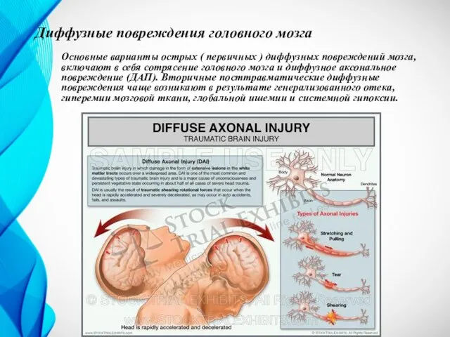 Диффузные повреждения головного мозга Основные варианты острых ( первичных ) диффузных повреждений