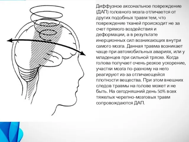 Диффузное аксональное повреждение (ДАП) головного мозга отличается от других подобных травм тем,