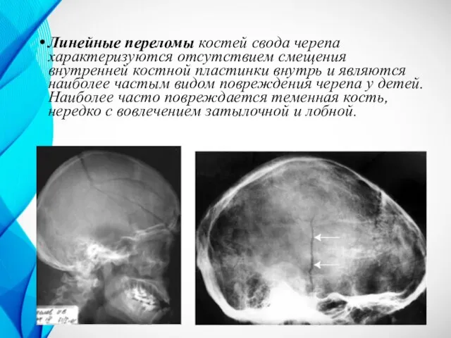 Линейные переломы костей свода черепа характеризуются отсутствием смещения внутренней костной пластинки внутрь