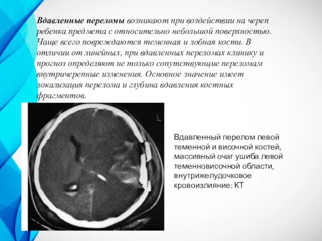 Вдавленный перелом левой теменной и височной костей, массивный очаг ушиба левой теменновисочной