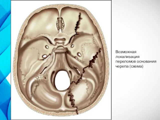 Возможная локализация переломов основания черепа (схема)