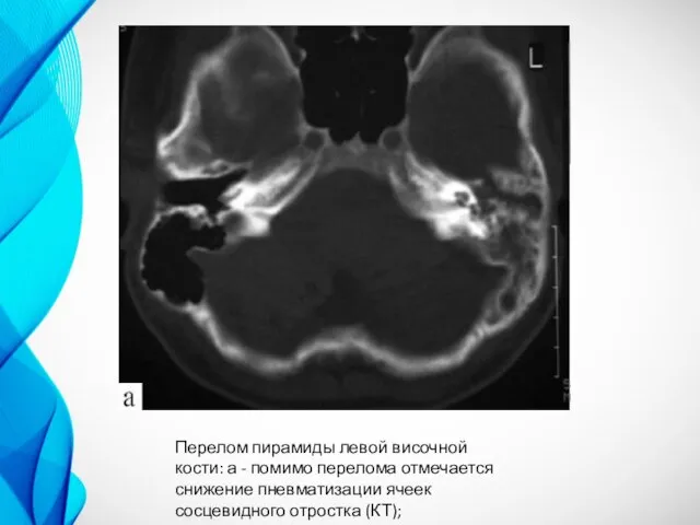 Перелом пирамиды левой височной кости: а - помимо перелома отмечается снижение пневматизации ячеек сосцевидного отростка (КТ);