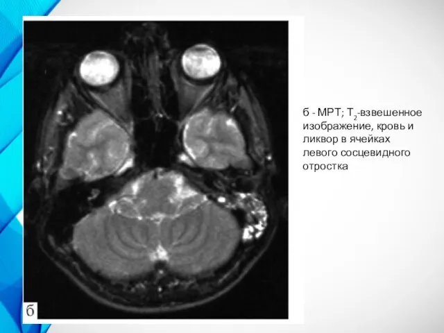 б - МРТ; Т2-взвешенное изображение, кровь и ликвор в ячейках левого сосцевидного отростка