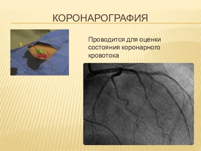 КОРОНАРОГРАФИЯ Проводится для оценки состояния коронарного кровотока