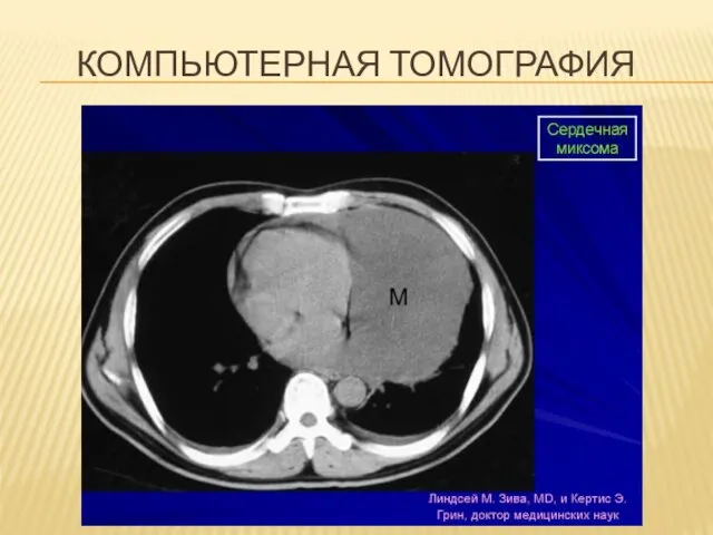 КОМПЬЮТЕРНАЯ ТОМОГРАФИЯ