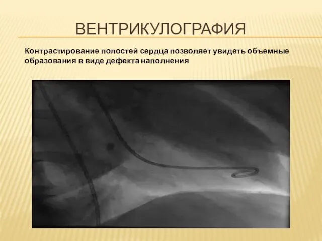 ВЕНТРИКУЛОГРАФИЯ Контрастирование полостей сердца позволяет увидеть объемные образования в виде дефекта наполнения