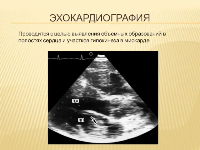 ЭХОКАРДИОГРАФИЯ Проводится с целью выявления объемных образований в полостях сердца и участков гипокинеза в миокарде.