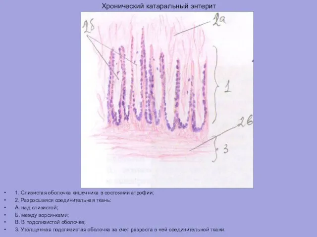 Хронический катаральный энтерит 1. Слизистая оболочка кишечника в состоянии атрофии; 2. Разросшаяся