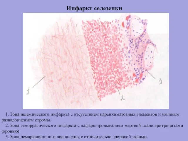 Инфаркт селезенки 1. Зона ишемического инфаркта с отсутствием паренхиматозных элементов и мощным
