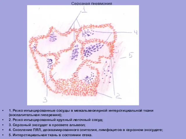Серозная пневмония 1. Резко инъецированные сосуды в межальвеолярной интерстициальной ткани (воспалительная гиперемия);