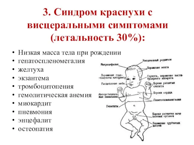 3. Синдром краснухи с висцеральными симптомами (летальность 30%): Низкая масса тела при