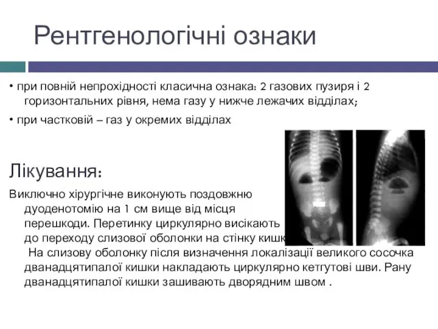 Рентгенологічні ознаки • при повній непрохідності класична ознака: 2 газових пузиря і