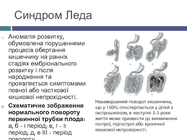 Синдром Леда Аномалія розвитку, обумовлена порушеннями процесів обертання кишечнику на ранніх стадіях