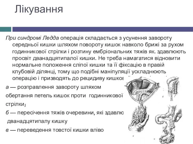 Лікування При синдромі Ледда операція складається з усунення завороту середньої кишки шляхом