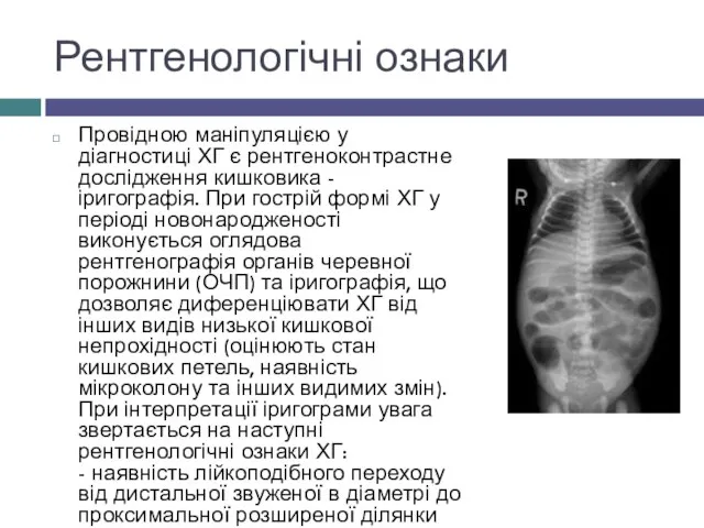 Рентгенологічні ознаки Провідною маніпуляцією у діагностиці ХГ є рентгеноконтрастне дослідження кишковика -