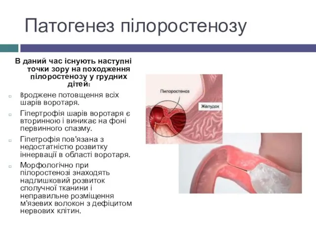 Патогенез пілоростенозу В даний час існують наступні точки зору на походження пілоростенозу