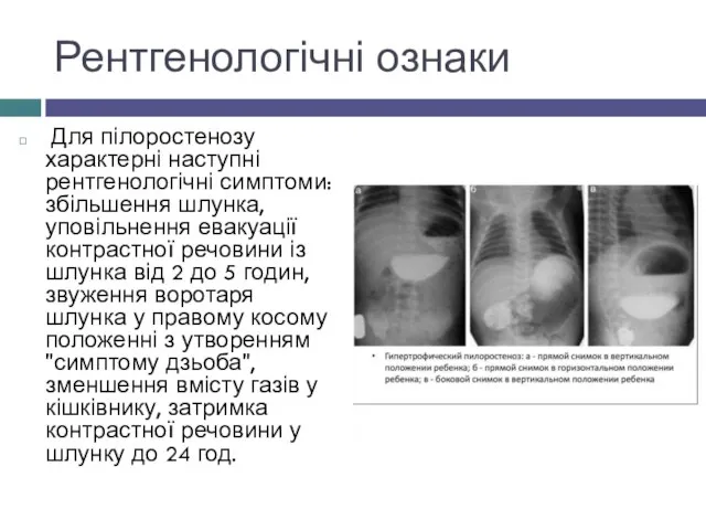 Рентгенологічні ознаки Для пілоростенозу характерні наступні рентгенологічні симптоми: збільшення шлунка, уповільнення евакуації