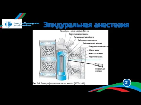 Эпидуральная анестезия