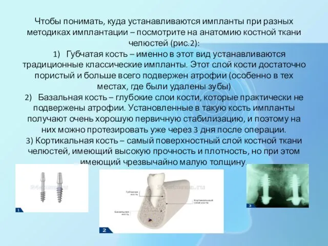 Чтобы понимать, куда устанавливаются импланты при разных методиках имплантации – посмотрите на